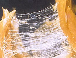 癒着した筋膜