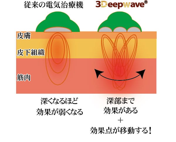 電気刺激